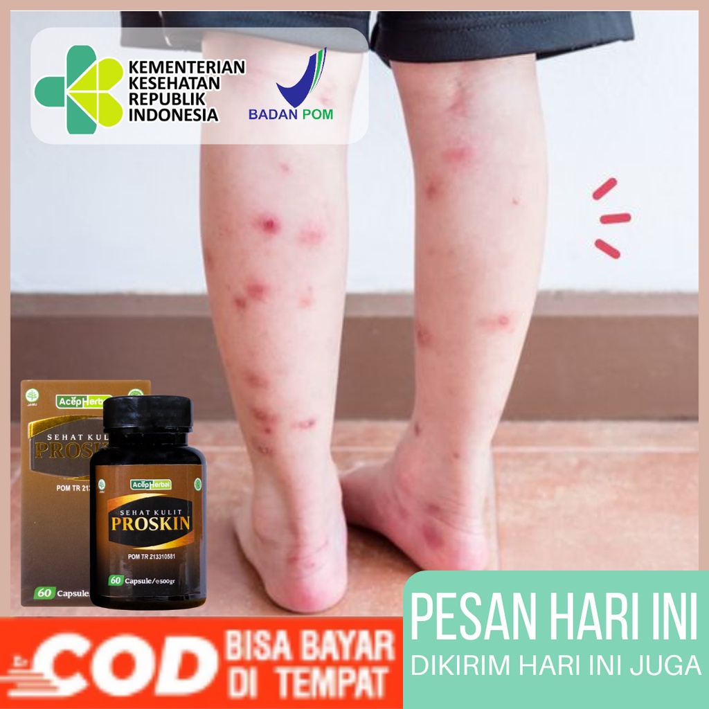 Jual Proskin Obat Gatal Prurigo Obat Darah Manis Obat Herbal Untuk