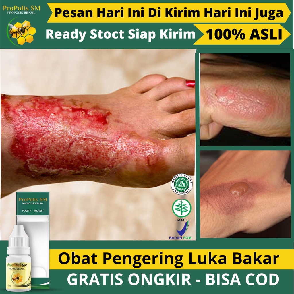 Jual Obat Oles Untuk Luka Tersiram Air Panas Tersiram Minyak Panas