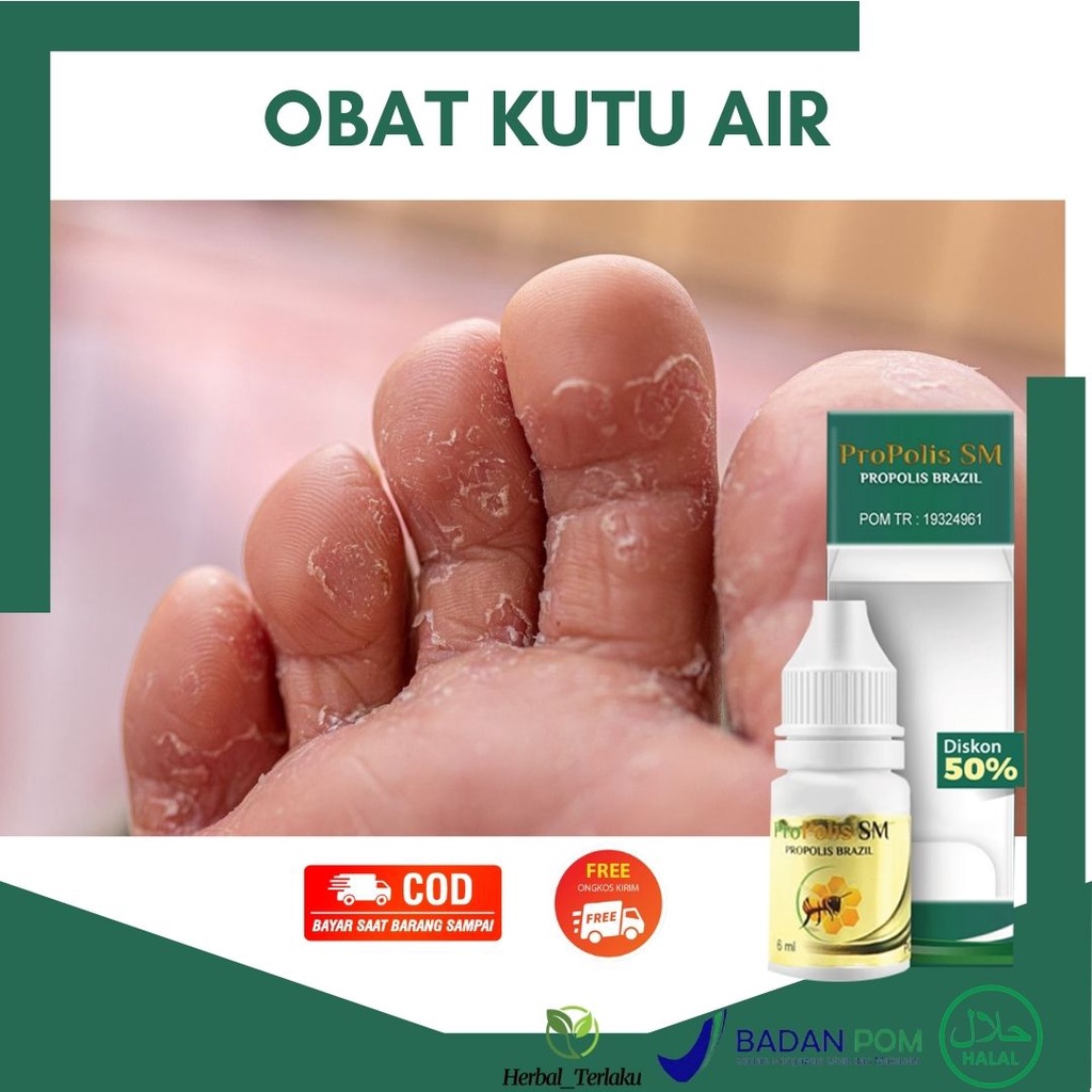 Jual Obat Kuman Air Di Sela Sela Jari Gatal Parah Panas Kutu Air Ruam Merah Bersisik