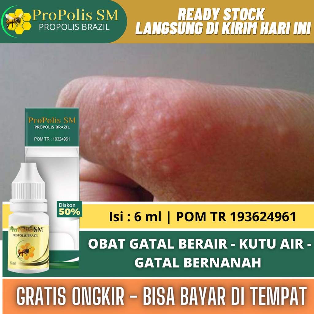 Jual Obat Gatal Berair Di Jari Tangan Dan Kaki Gatal Berair Dan