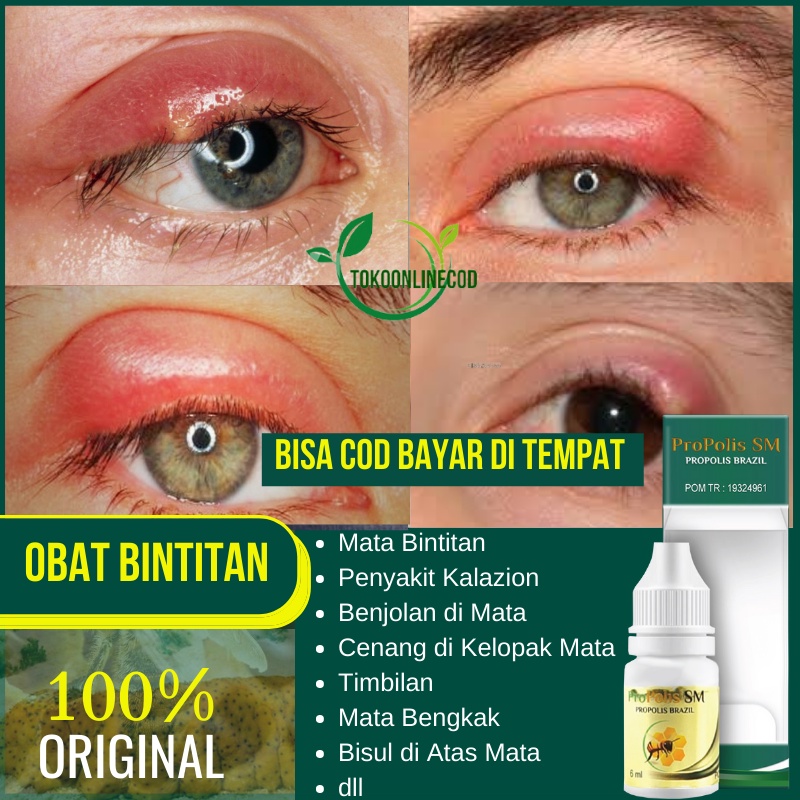 Jual Obat Bintitan Bintitan Di Kelopak Mata Hordeolum Mata Bintitan Kalazion Penghilang