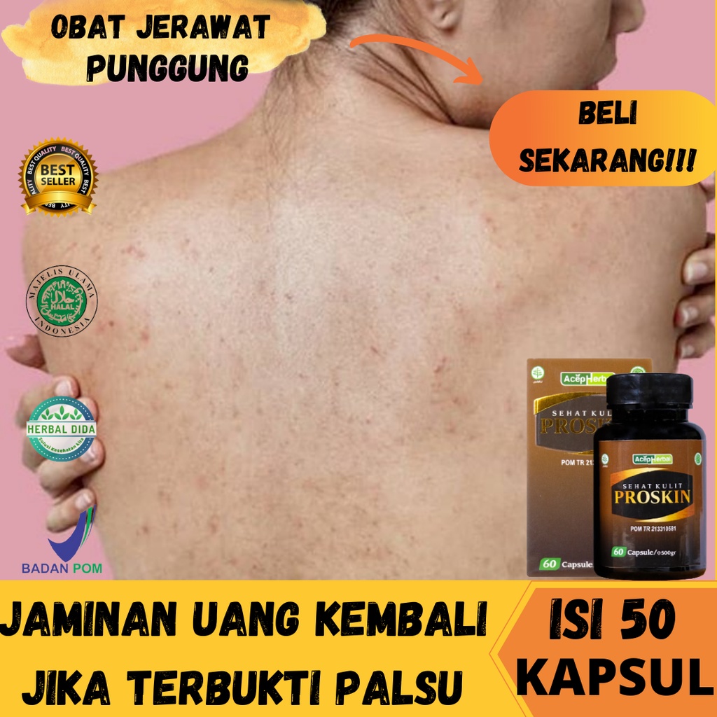 Jual Obat Jerawat Punggung, Obat Jerawat di Punggung Dan Bekasnya, Obat