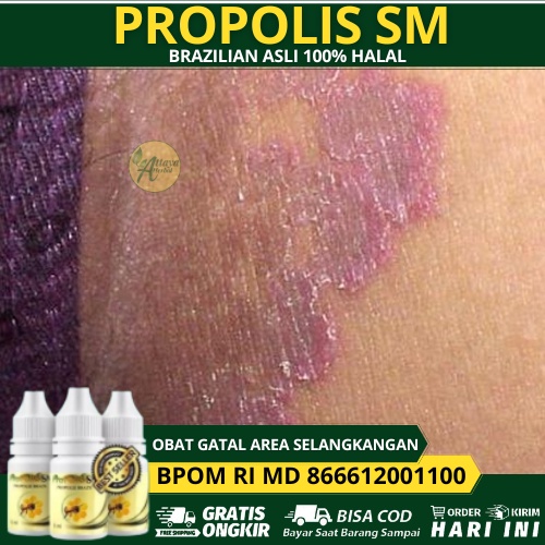 Jual Obat Gatal Area Selangkangan, Gatal Di Selangkangan, Gatal Di