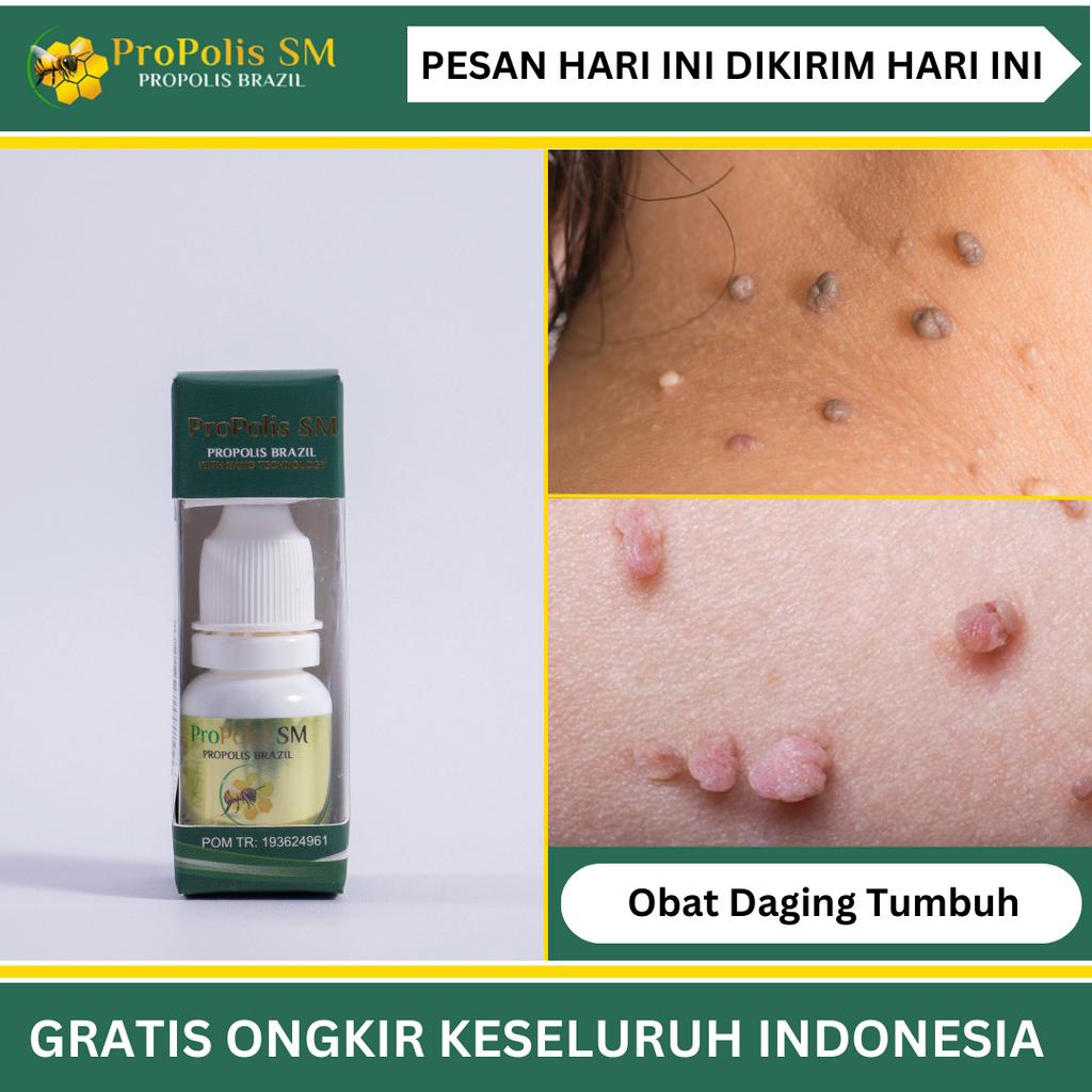 Jual Propolis Sm Atasi Daging Tumbuh/Skin Tag, Kutil Di Kulit/Kelamin