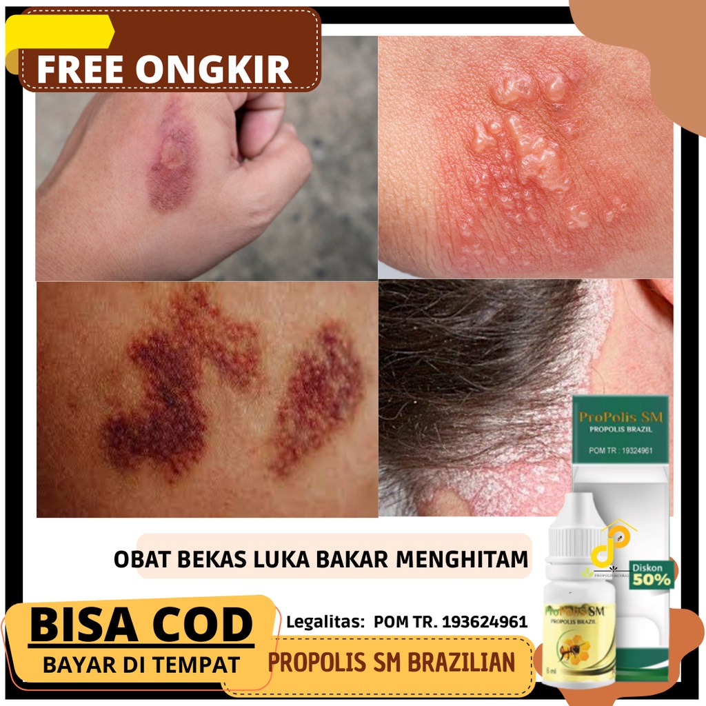 Jual Obat Penghilang Bekas Luka Paling Laku Bekas Luka Bakar Yang Menghitam Luka Bakar