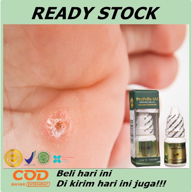 Jual Obat Mata Ikan Di Kaki Obat Perontok Mata Ikan Obat Penghilang