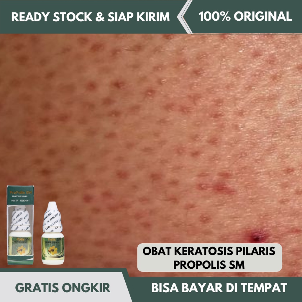 Jual Obat Keratosis Pilaris Obat Penyakit Kulit Seperti Kulit Ayam