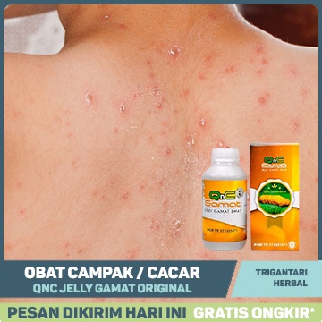 Jual Obat Campak Anak dan Dewasa Cacar Api, Cacar Ayam, Cacar Monyet