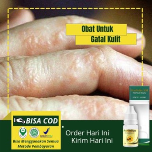 Jual Obat Gatal Berair - Kulit Melepuh, Eksim/Eksem, Penyakit Kulit
