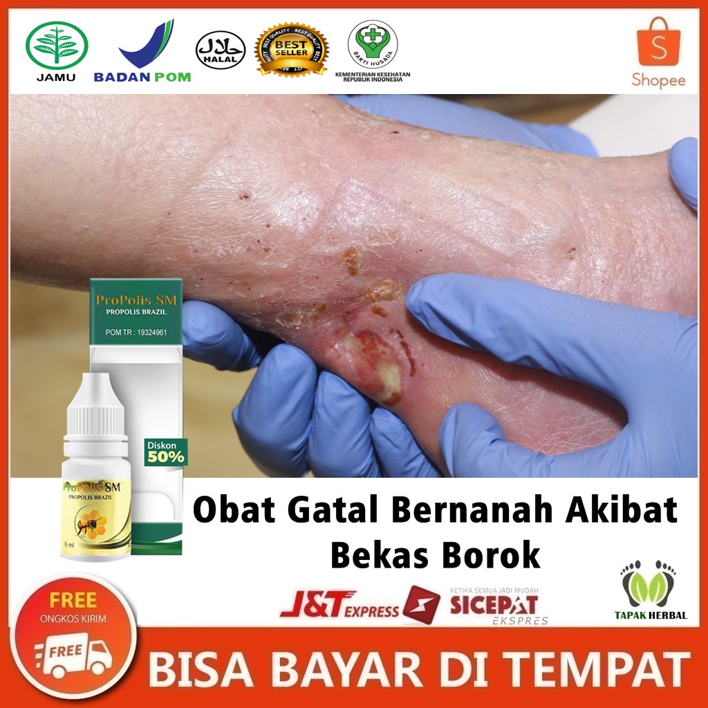 Jual Obat Gatal Bernanah Di Telapak Tangan Obat Gatal Di Sela Jari Tangan Dan Kaki Obat Gatal 5081