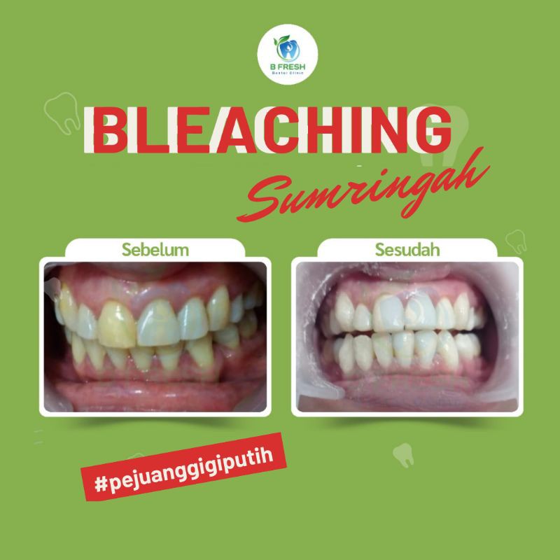 Jual VOUCHER DP BLEACHING Memutihkan Gigi Klinik Dokter B FRESH DENTAL ...