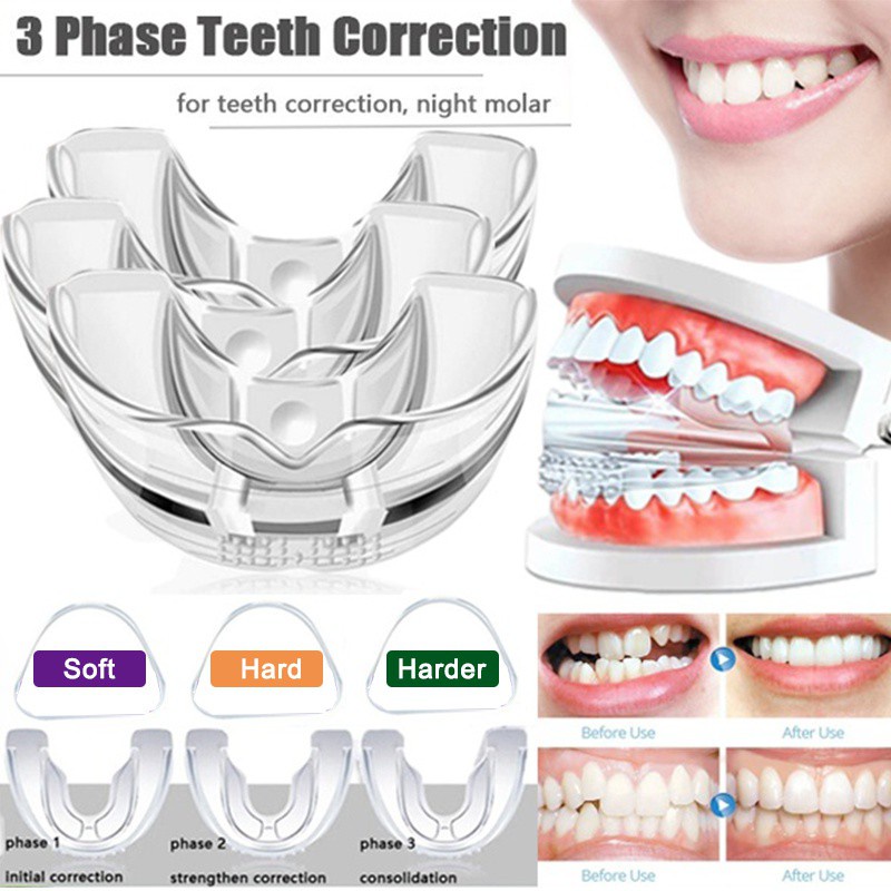 Jual Teeth Orthodontic Appliance Alignment Teeth Retainer Bruxism Mouth ...