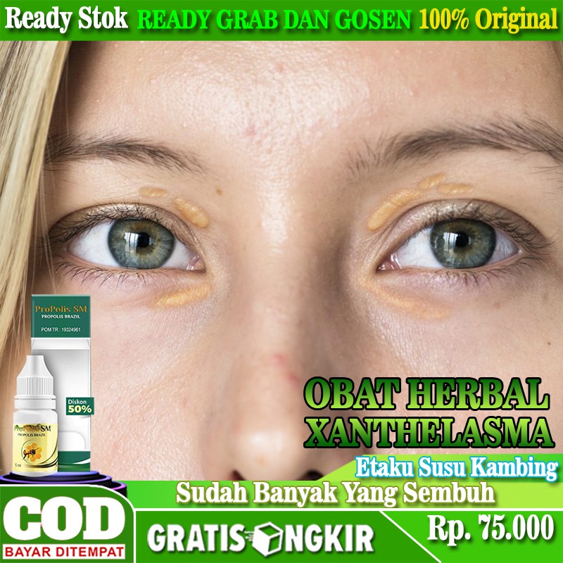 Jual Obat Herbal Penghilang Xanthelasma, Plak Kekuningan Di Bawah Mata ...