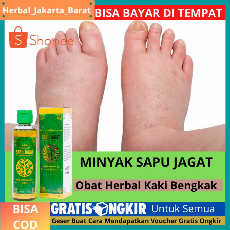 Jual Obat Kaki Tiba Tiba Membengkak Sehabis Jatuh Luka Kaki Bengkak