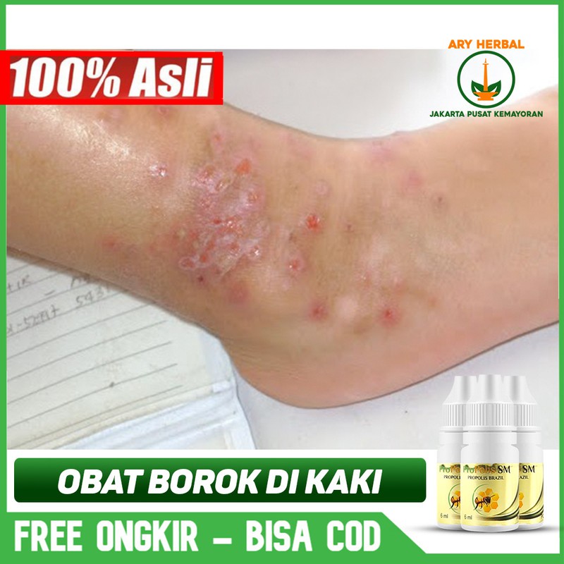 Jual Obat Borok Di Kaki, Tangan, Infeksi Karena Luka Herbal Terlaris