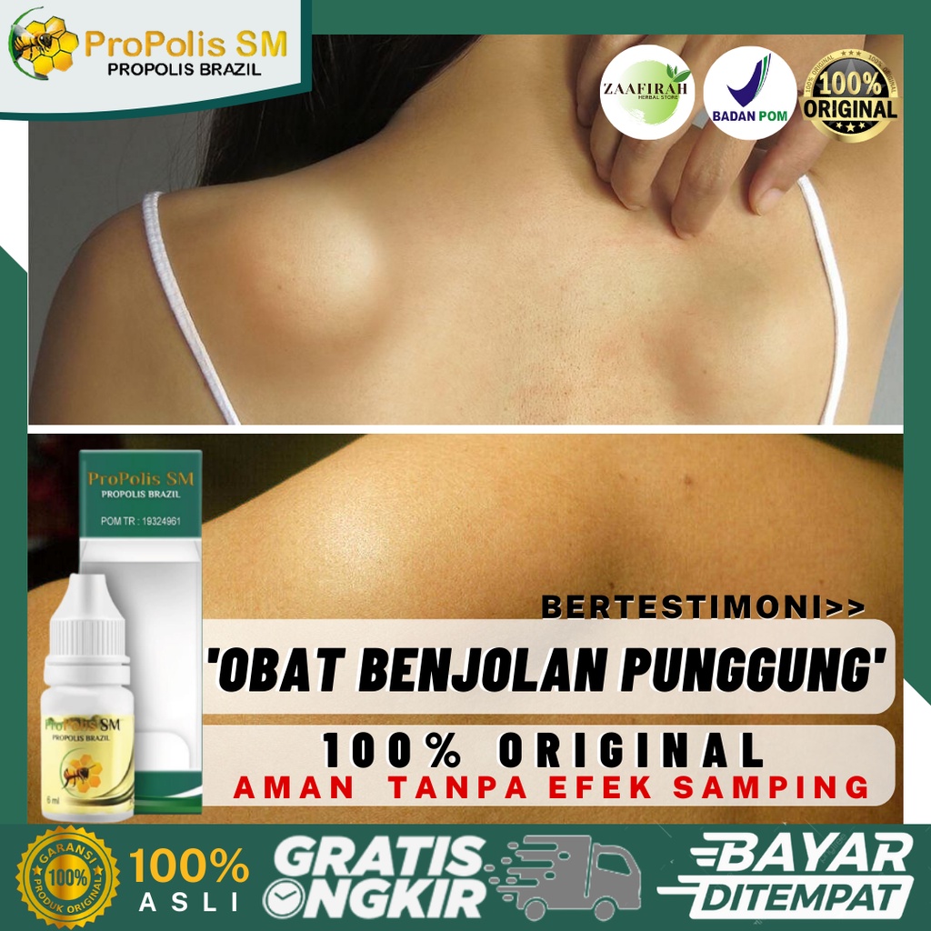 Jual Obat Benjolan Di Punggung Obat Herbal Benjolan Di Pundak Obat ...