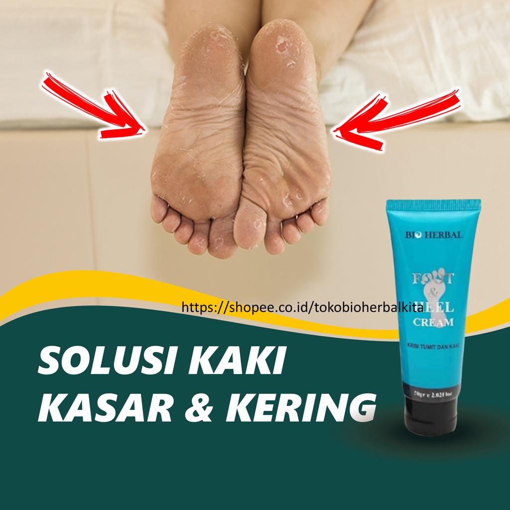 Jual Salep Kaki Pecah Dan Kering Ampuh Obat Telapak Kaki Pecah Obat ...