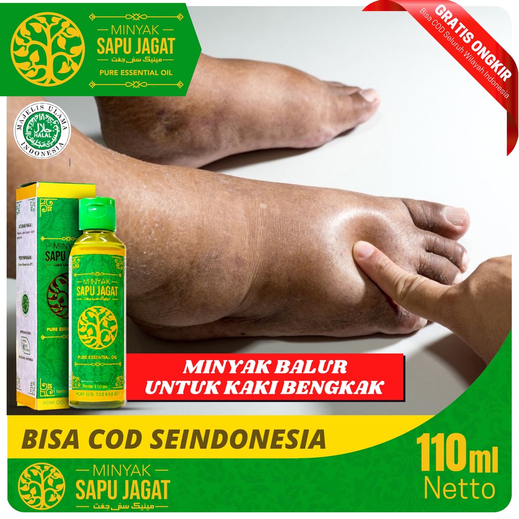 Jual Minyak Balur Untuk Kaki Bengkak Karena Jantung Ginjal Asam Urat Diabetes Dan Keseleo Obat