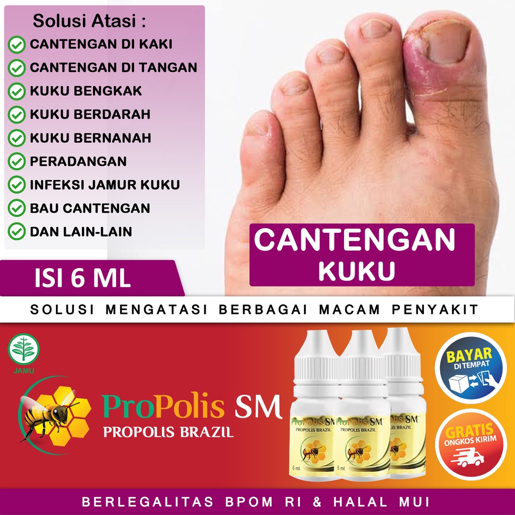 Jual Obat Oles Cantengan Di Kuku Tangan Dan Kaki Cantengan Berdarah