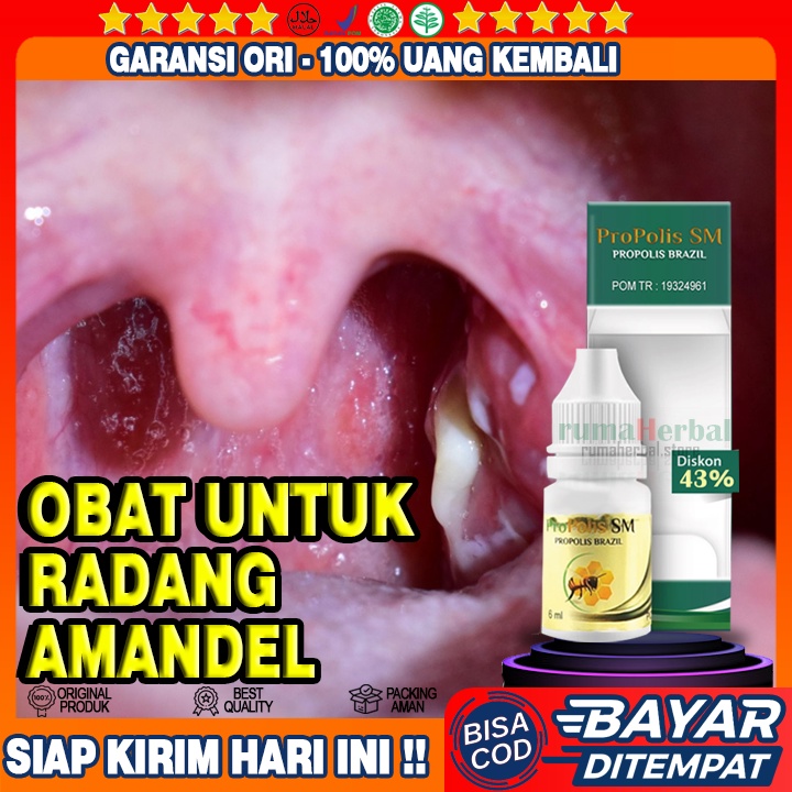 Jual Obat Radang Amandel Amandel Bengkak Radang Tonsil Obat Amandel