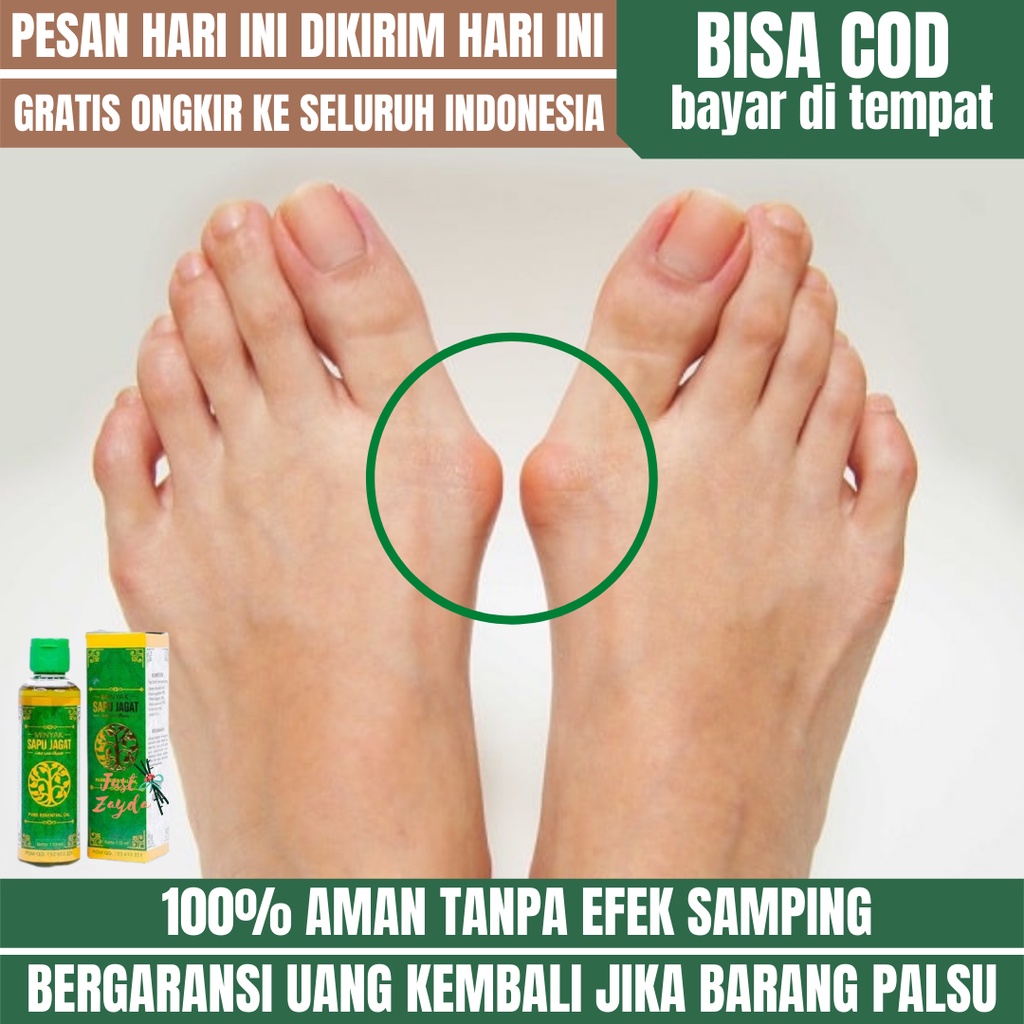 Jual Obat Oles Bunion Obat Benjolan Di Kaki Obat Sakit Kaki Bunion