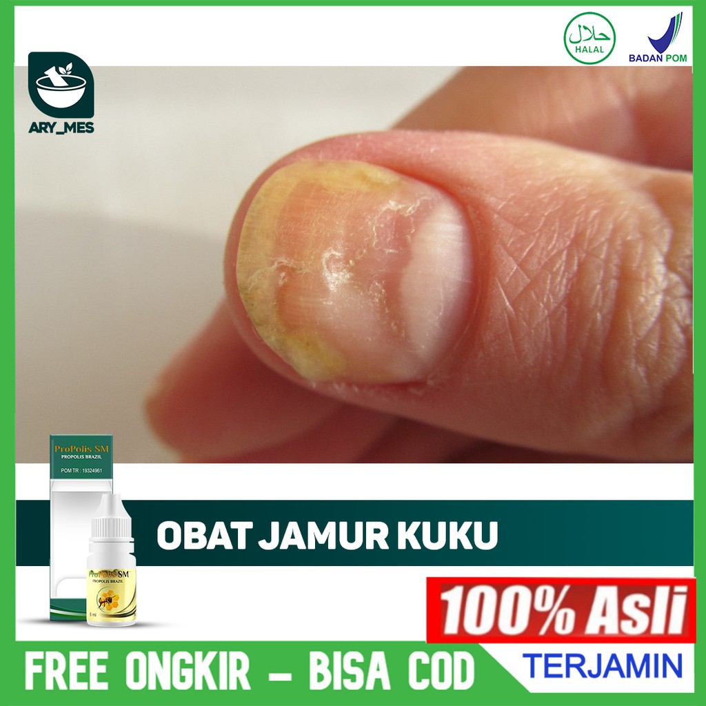 Jual Obat Jamur Kuku tangan dan Kaki Kuku Rusak Bergelombang, Jamuran