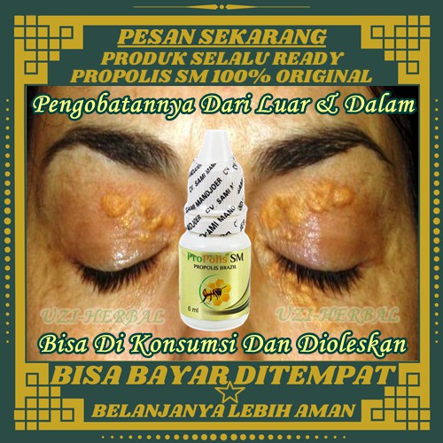 Jual Propolis SM - Obat Gumpalan Lemak Kelopak Mata - Penghilang ...