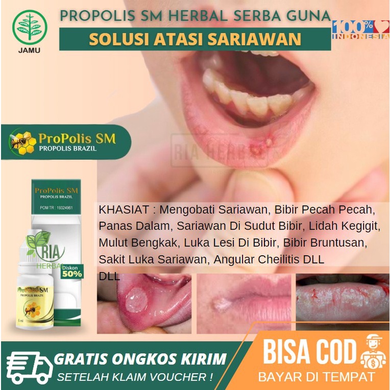 Jual Obat Sariawan Luka Di Mulut Obat Gusi Mulut Berdarah Napas Bau