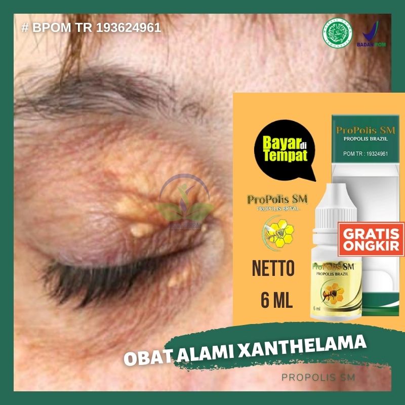 Jual SALEP XANTHELASMA, OBAT PENGHILANG GUMPALAN LEMAK DI KELOPAK MATA ...