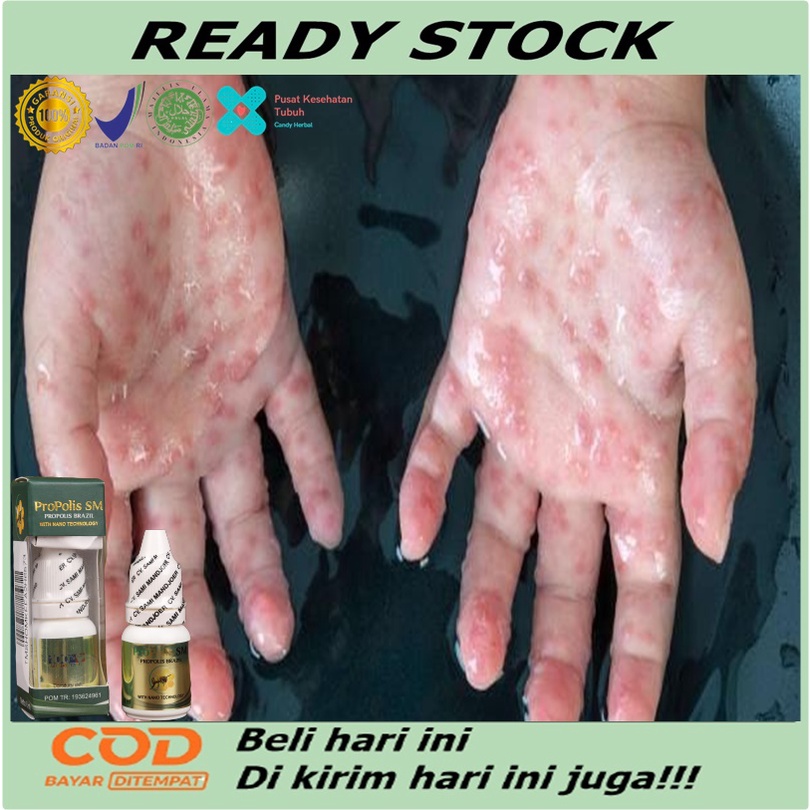 Jual Obat Gatal Berair Di Jari Tangan Dan Kaki Obat Bintik Bening Berair Gatal Bernanah 8518