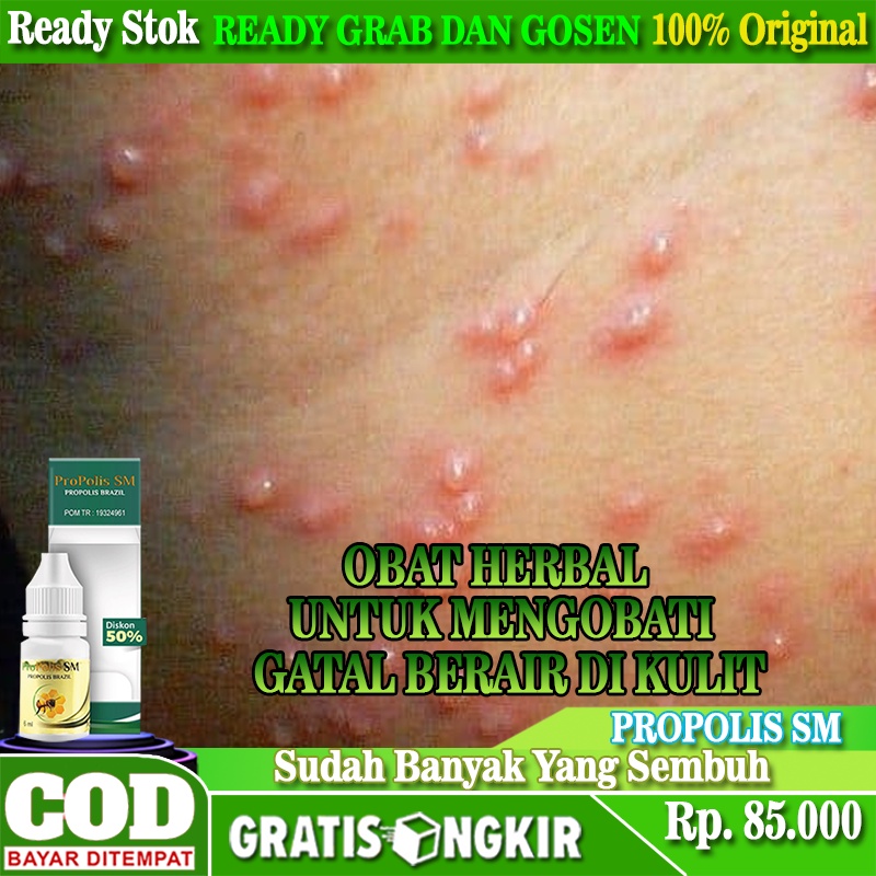 Jual Obat Gatal Berair Di Kulit, Obat Gatal Alergi Pada Kulit, Obat