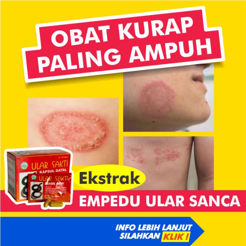 Jual Obat Kurap Kudis Paling Ampuh Gatal Kulit Gatel Kadas Eksim Kering