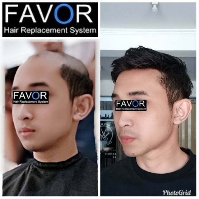 Wig Rambut Toupee Pria solusi kebotakan rogaine minoxidil