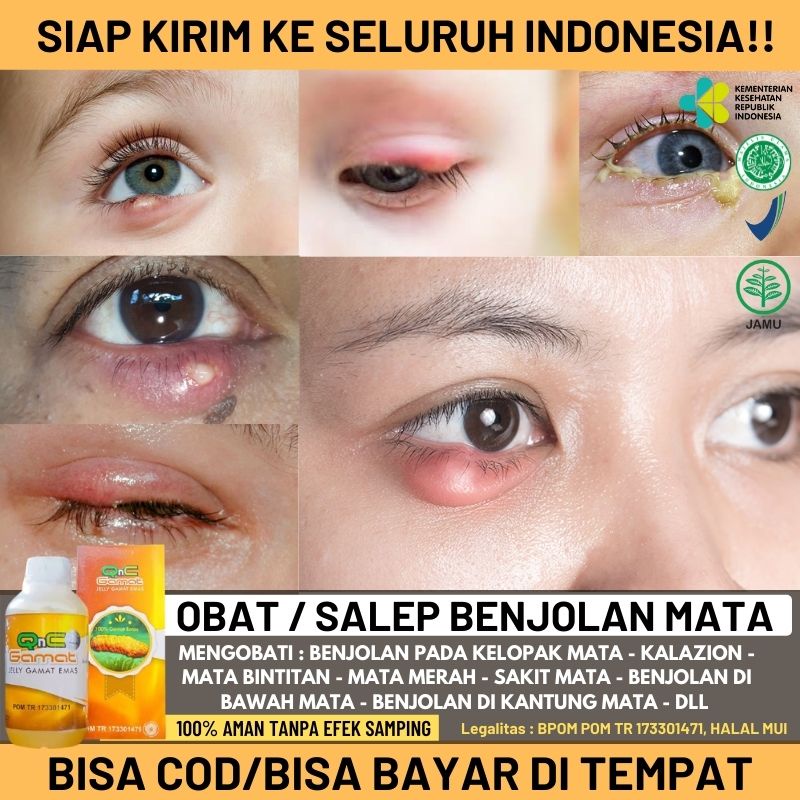 Jual Obat Atau Salep Kalazion Benjolan Di Mata / Benjolan Di Kelopak ...