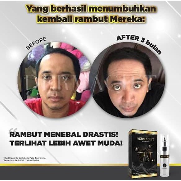 Jual Dermagift Penumbuh Rambut Botak Bergaransi, Obat Botak, Obat ...