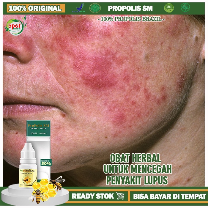 Jual Obat Pencegah Penyakit Lupus, Mengatasi Gejala Lupus, Bercak Merah