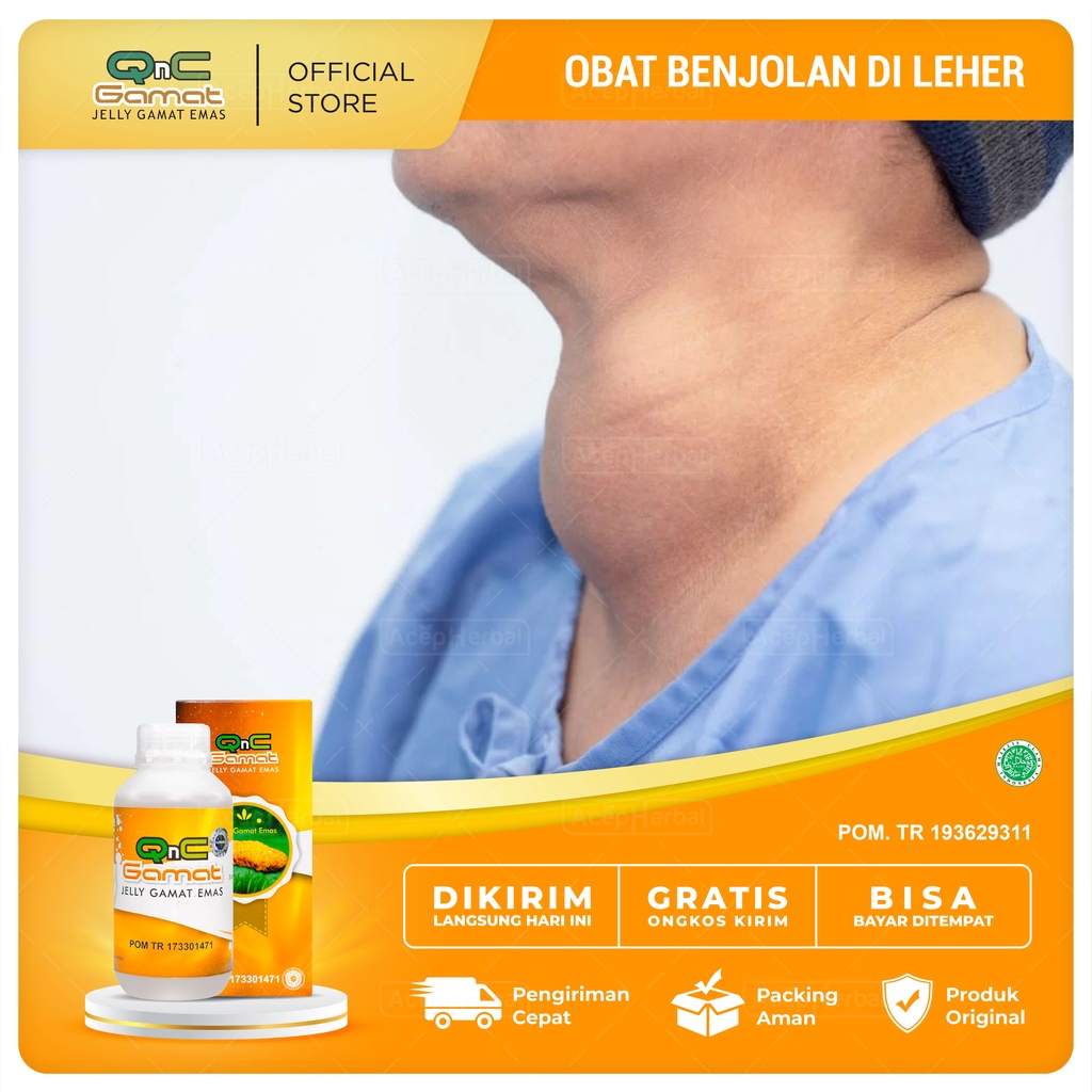 Jual Obat Benjolan Di Leher Belakang Kelenjar Getah Bening Bengkak Obat Herbal Gondok Nodul 