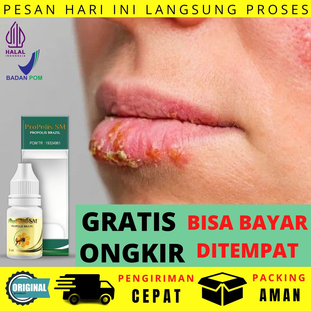 Jual Obat Herpes Dompo Kelamin Pria Luka Lepuh Bayi Anak Alami Benjolan ...