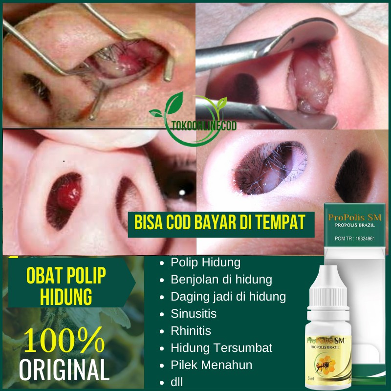 Jual Obat Tetes Polip Hidung Penghilang Benjolan Dihidung Daging Tumbuh Daging Jadi Di