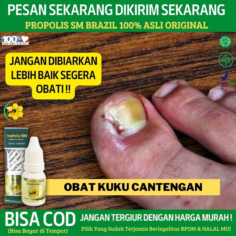 Jual Obat Tetes Kuku Cantengan Bernanah And Bau Obat Kuku Kaki Bengkak