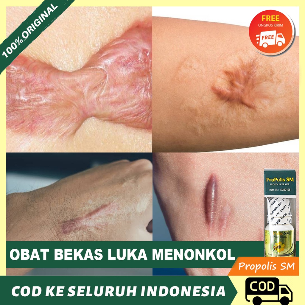 Jual Obat Bekas Luka Menonjol Penghilang Keloid Keloid Menahun