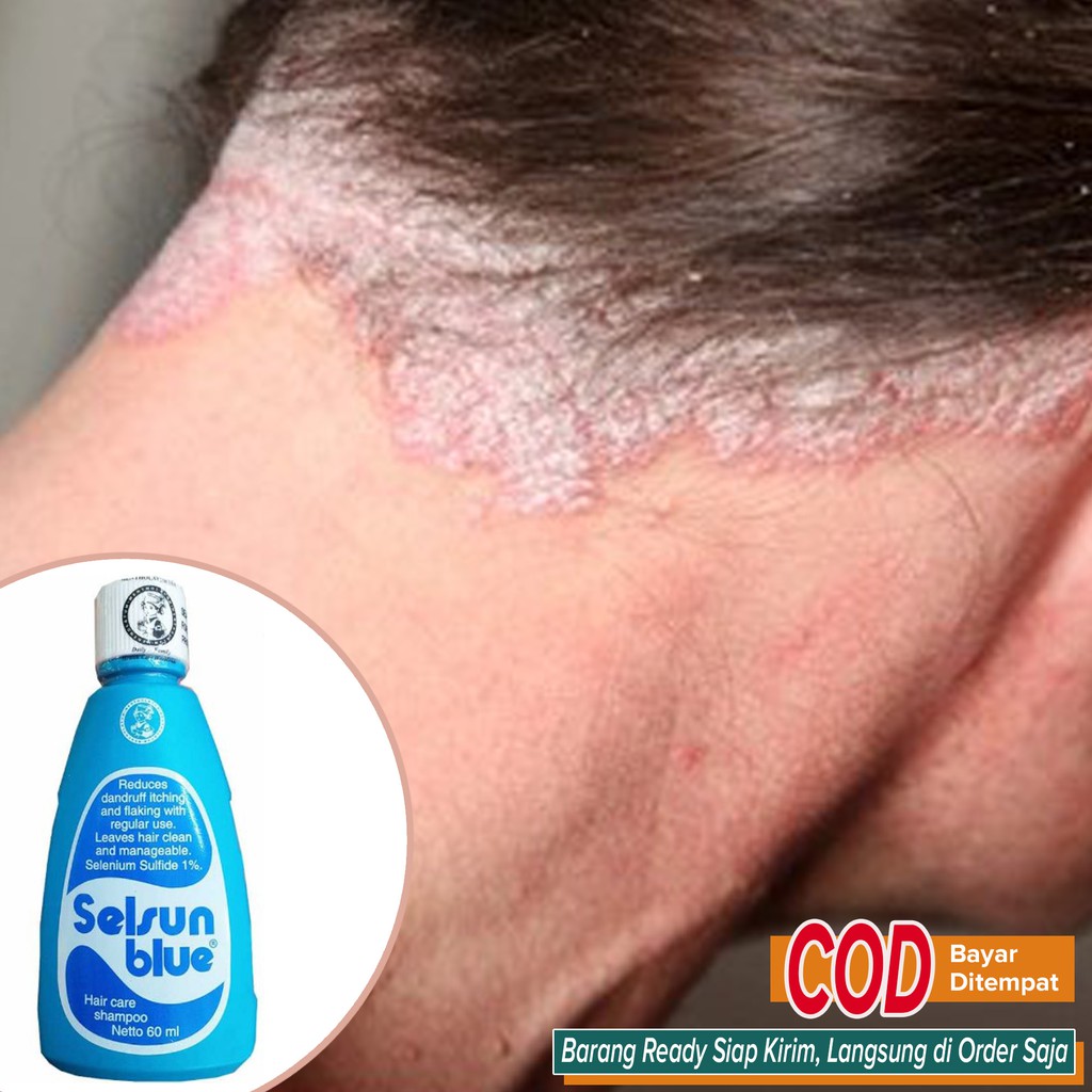 Jual Pembersih Penghilang Ketombe AMPUH Jamur Kulit gatal Kepala BERSIH