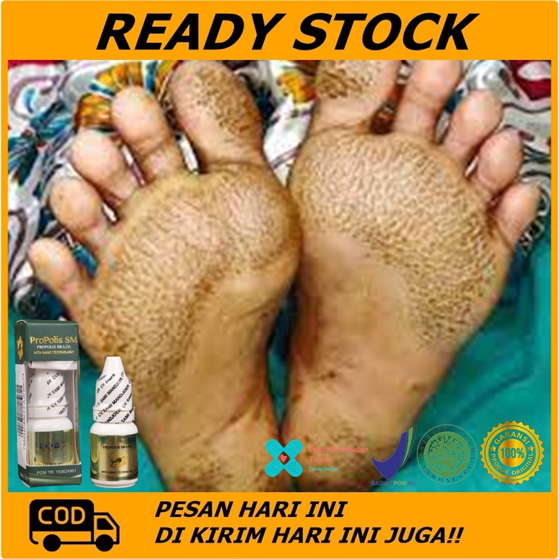 Jual Obat telapak kaki bau, obat penghilang telapak kaki rayapan,obat ...