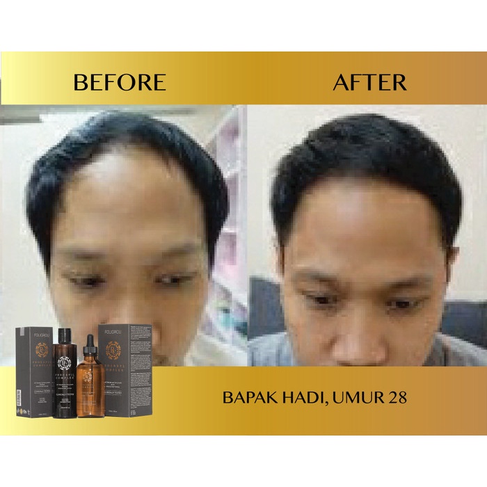 Jual RAMBUT-VITAMIN-SUPLEMEN- FOLIGROU HAIR TONIC DAN SHAMPOO PENUMBUH ...
