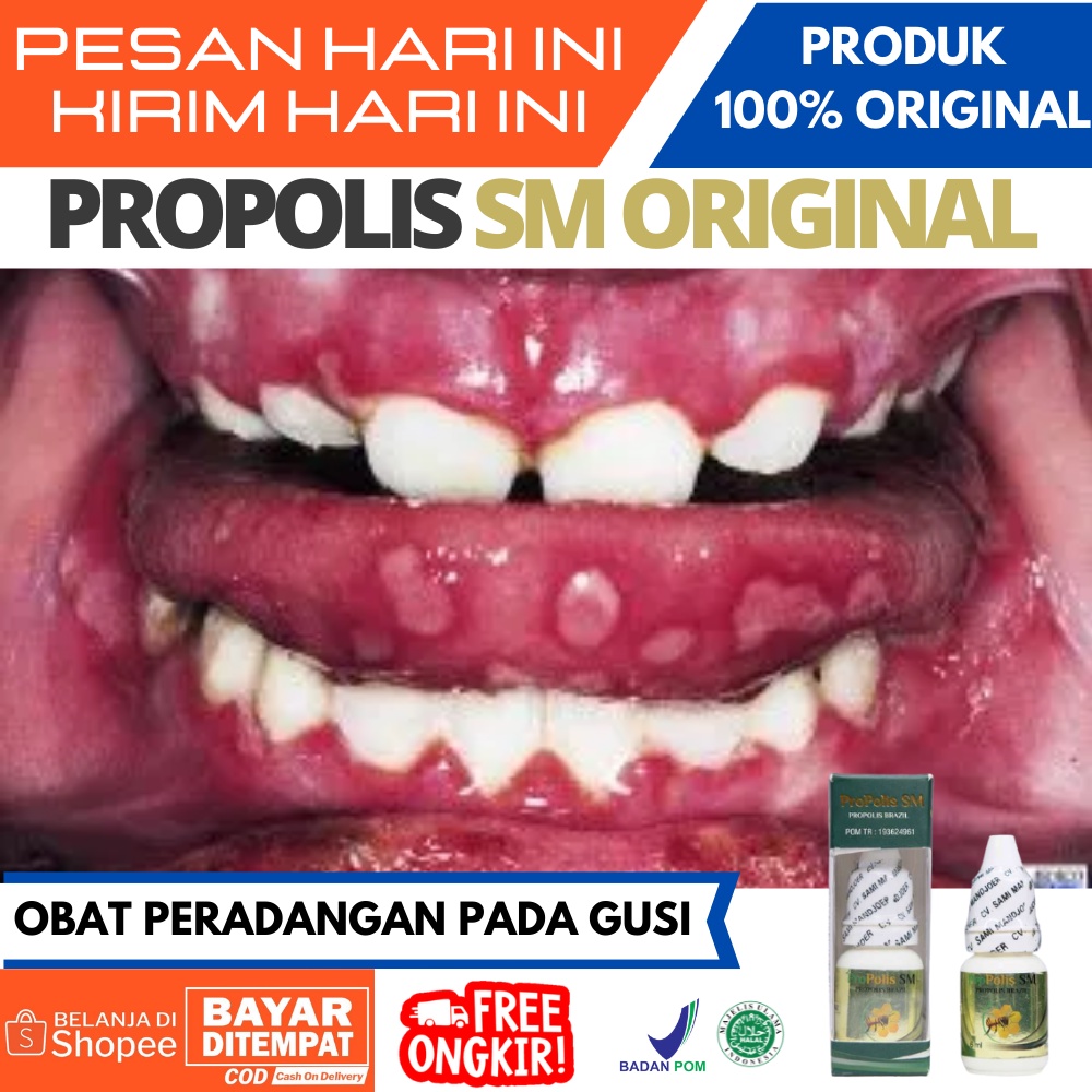 Jual Obat Radang Gusi / Gingvitis, Gusi Bengkak, Berdarah, Gusi Bau ...