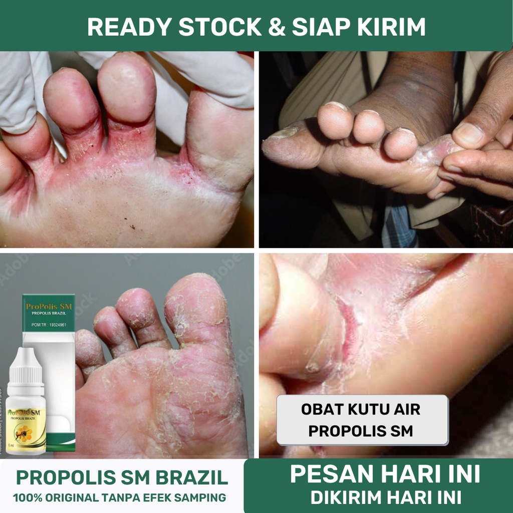 Jual Obat Kutu Air Di Jari Tangan Dan Kaki Obat Penghilang Kutu Air Obat Gatal Kaki Obat 2862