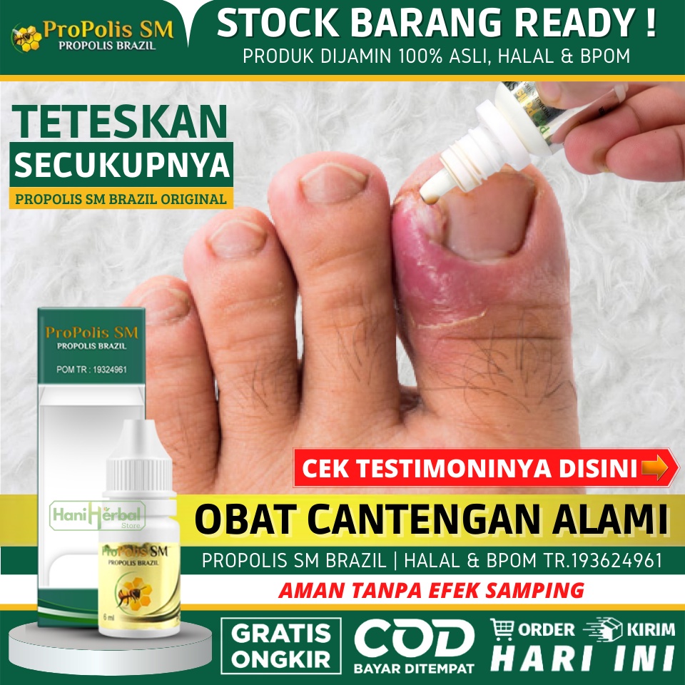 Jual Obat Cantengan Sakit Kuku Jari Jempol Kaki Tangan Bengkak Canteng