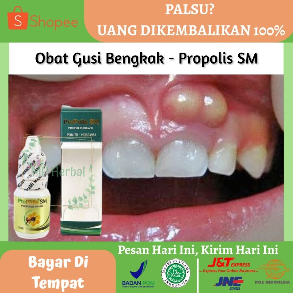 Jual Obat Gusi Bengkak, Obat Gusi Bengkak Bernanah, Obat Gusi Bengkak