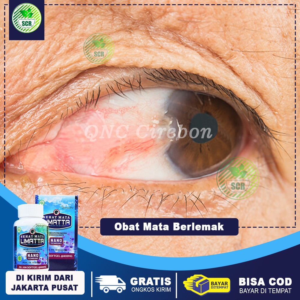 Jual Obat Mata Berlemak Obat Pterygium Obat Mata Rabun Mata Minus