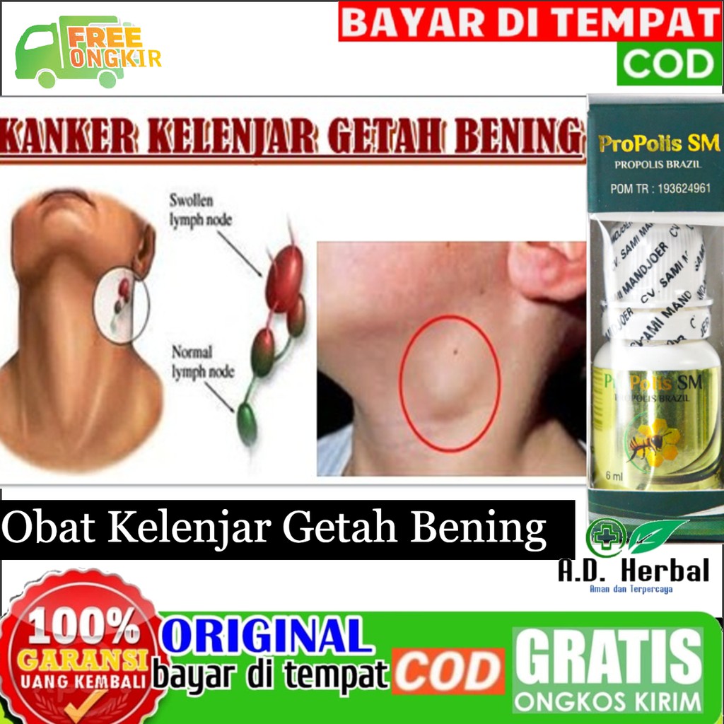 Obat Kelenjar Getah Bening,Kanker Tumor Jinak,Benjolan Di Leher 100% ORI BISA COD Propolis SM